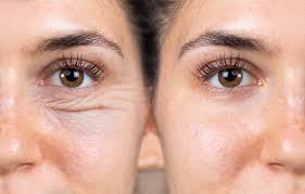 Skin Rejuvenation